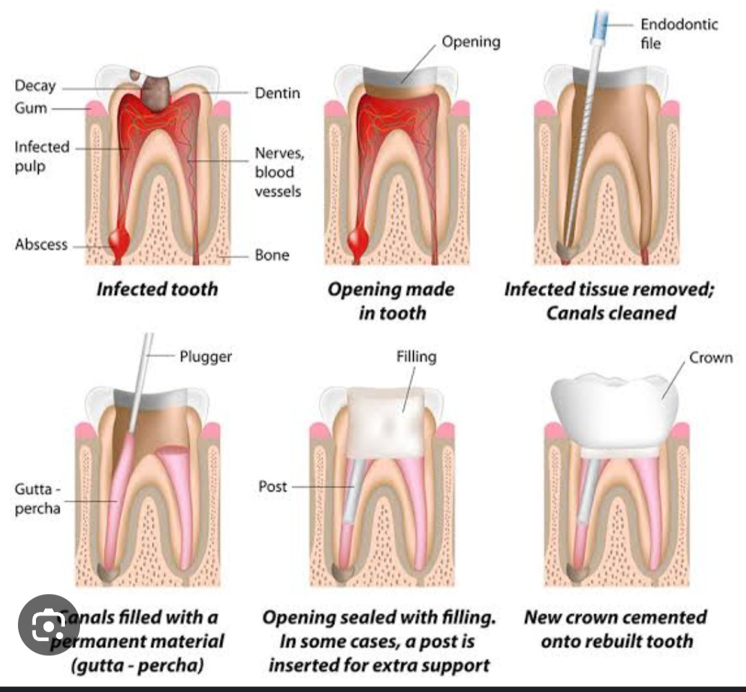 Advanced root canal treatment at Dr. Garg’s Clinic using modern rotary tools in a painless, single-sitting procedure